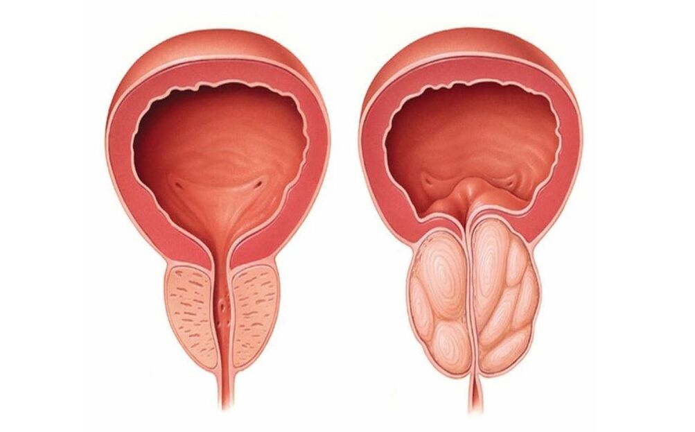 normal at inflamed prostate