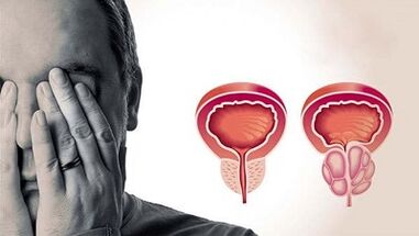 Ang mga kadahilanan para sa pagpapaunlad ng prostatitis sa mga kalalakihan