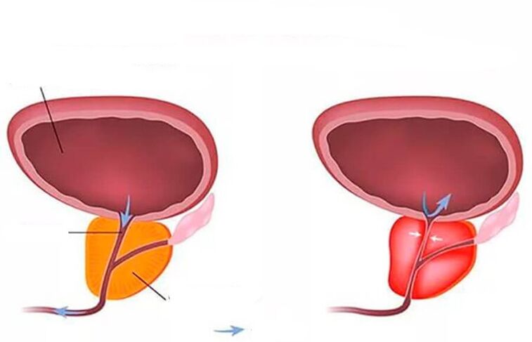 normal at namumula na prostate