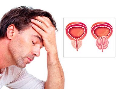 Ang mga sintomas ng prostatitis ay nag-aalala sa isang lalaki