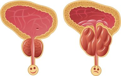 Malusog at inflamed male prostate