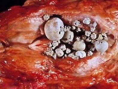 Mga bato sa prostate gland na may calculous prostatitis