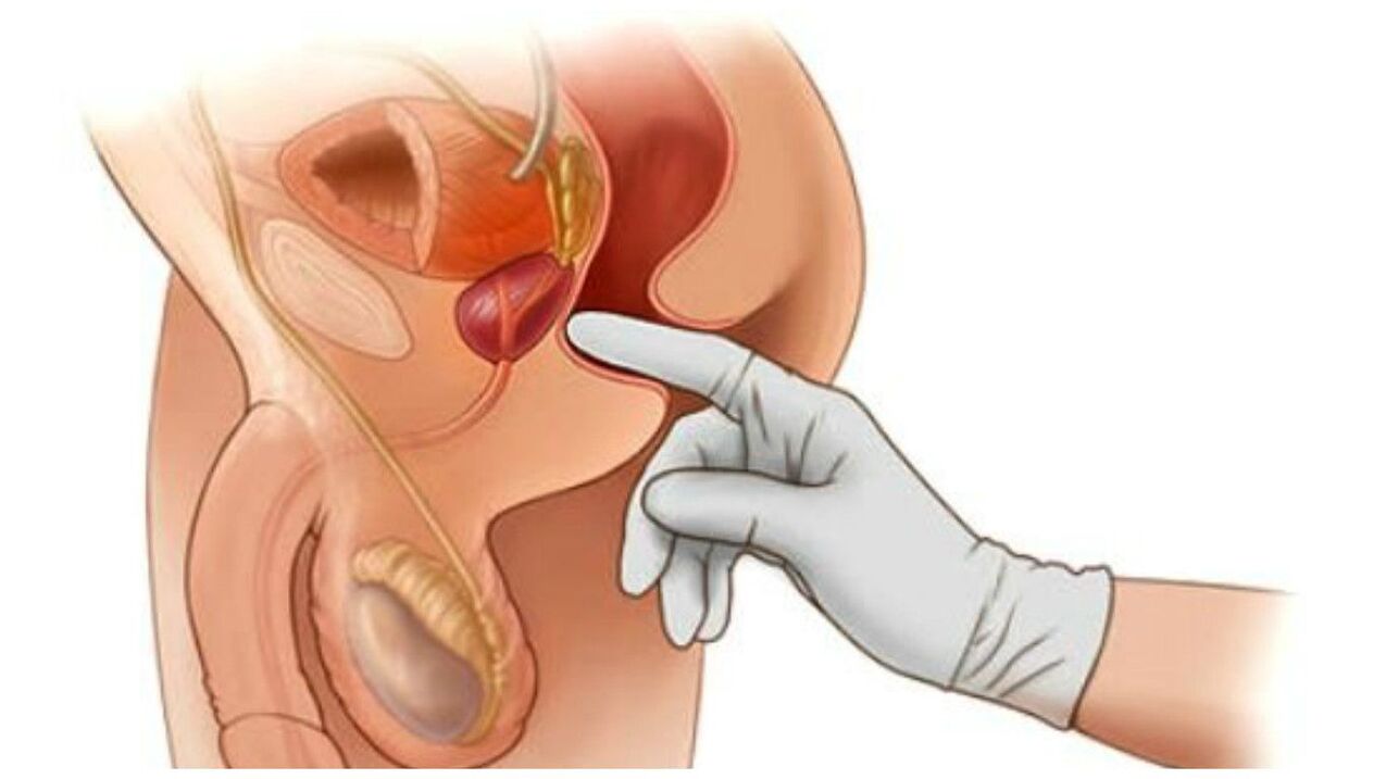 prostate massage
